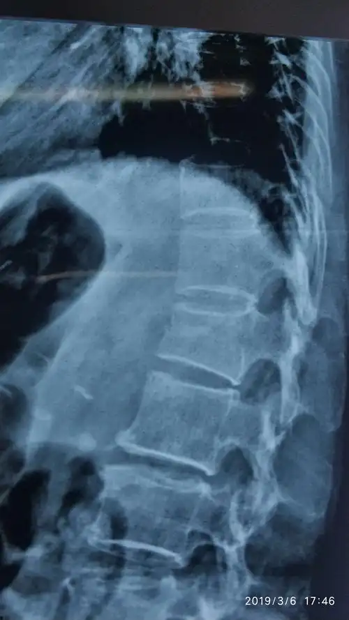 来我院影像检查提示:腰1椎体压缩性骨折.