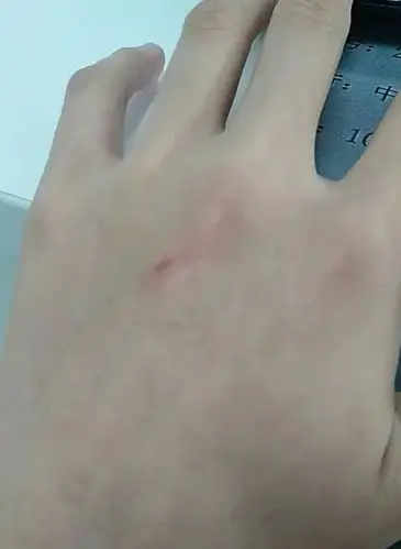 惊!贵阳市民上班途中被一只大狗抓伤手,然而狗主人给了200块后走了