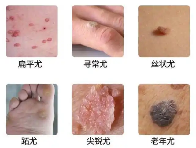 脚底长了"跖疣",脸上长了"扁平疣"手上长了"瘊(hou)子"经常听别人说