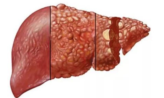 【患者关心】肝纤维化和肝硬化有啥区别?