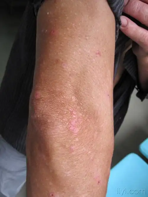 看图识病13-公布答案:多形日光疹