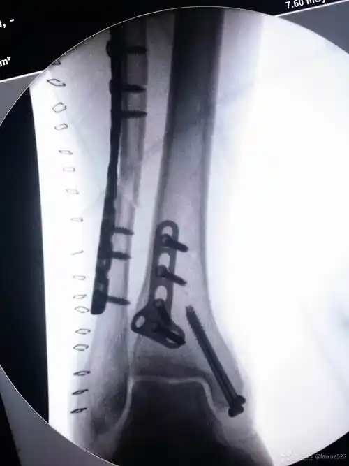 中年男性踝关节骨折旋前外旋iv