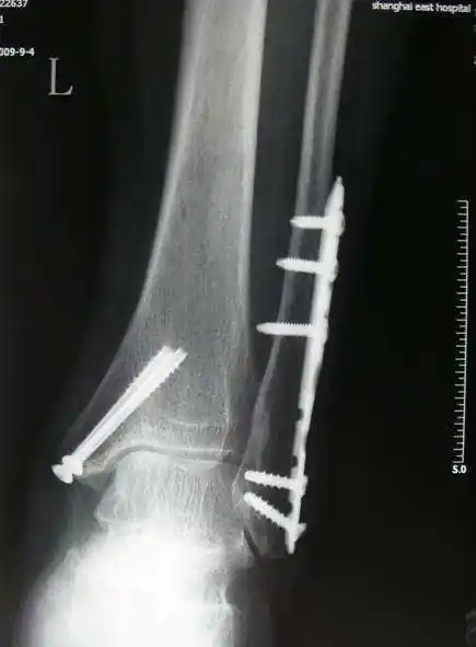 微创双踝骨折术后取内固定