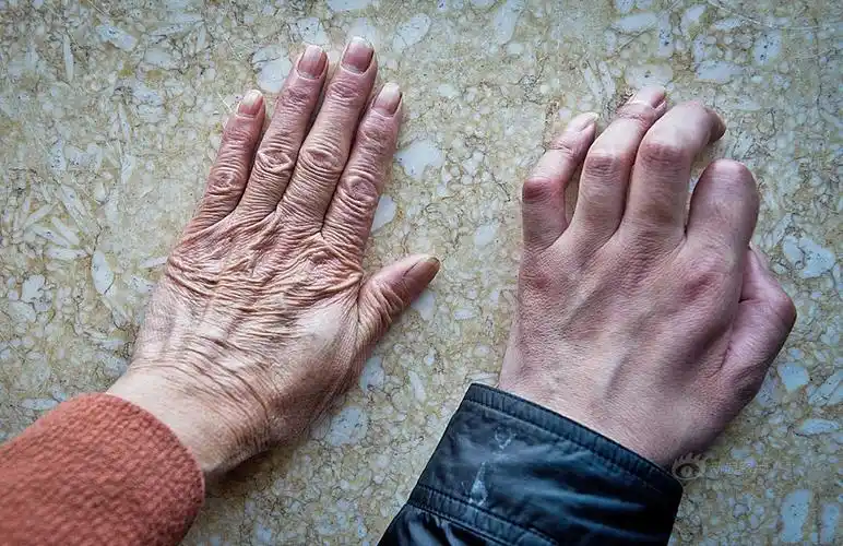 霍金为何是最长寿渐冻人并不因为他是外星人派来的而是因为