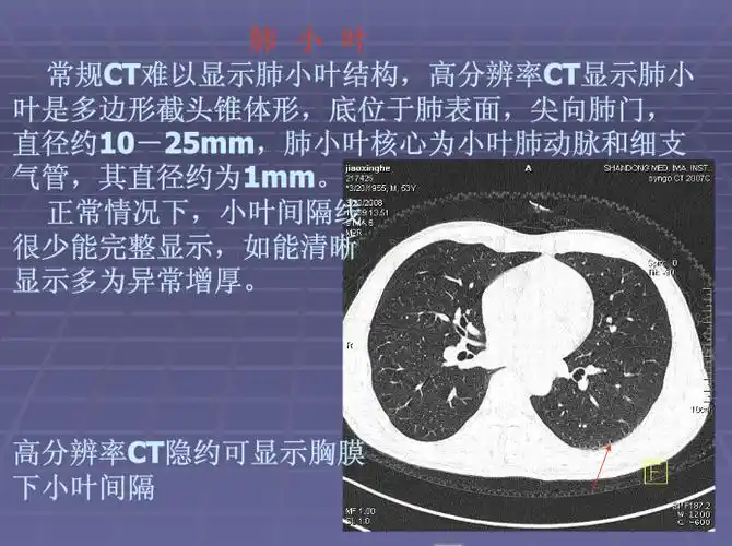 正常胸肺部ct影像学