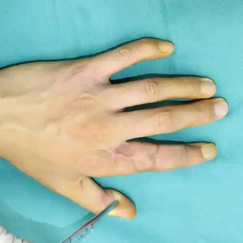 手指再造哪家医院做的好?_移植_时间_脚趾