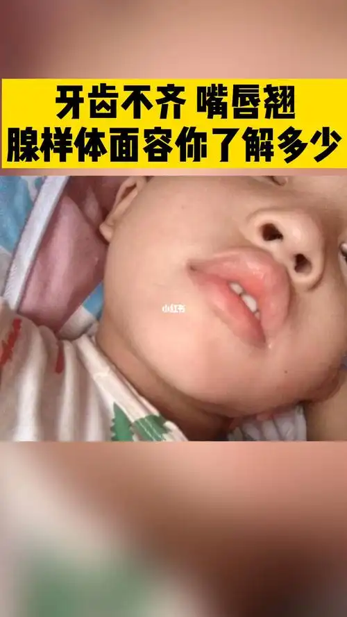 腺样体面容特征有哪些你了解多少