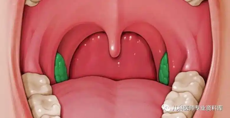 正常的扁桃体图片「正常的扁桃体图片和发炎的图片」_友友