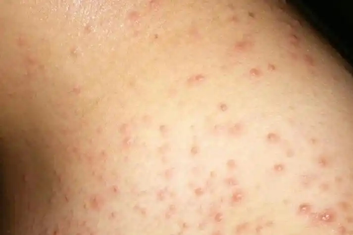 艾滋病肩膀上长了痘痘图片_有来医生