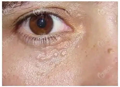 扁平疣脂肪粒汗管瘤还没分清楚那来看它们的区别图吧