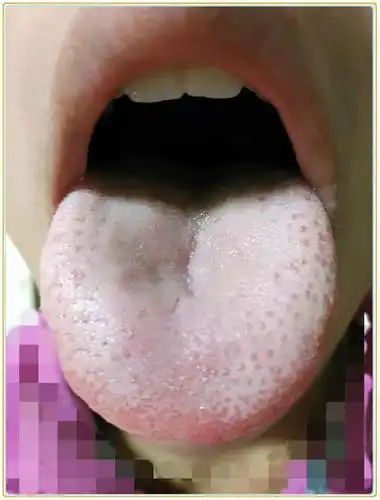 孩子舌苔满布舌体,中间厚,这是湿气与积食混杂的状态啊!