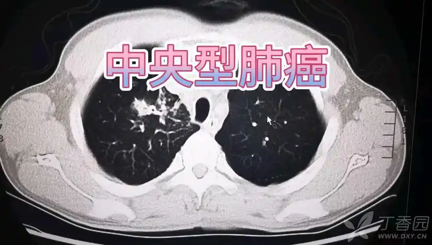 中央型肺癌一例直接征象和间接征象都有哪些