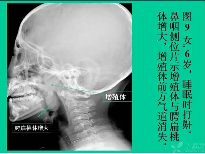 请大家帮忙分析一下腺样体肥大的影像表现,有没有正常的图片 [病例帖]