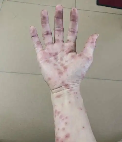 4月12日,手上红疹已经不再继续增多. | 作者供图4月14日背部结痂掉皮.