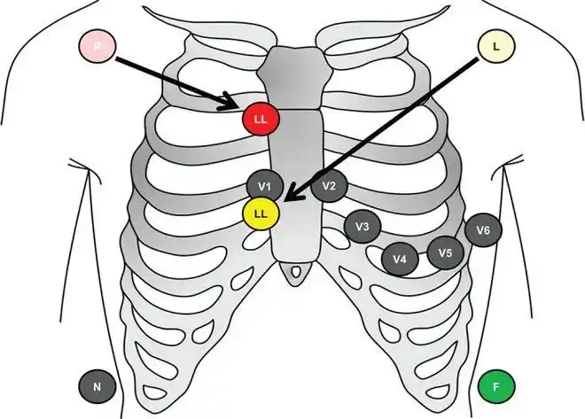 心电图有问题别急先看看导联位置放对了吗
