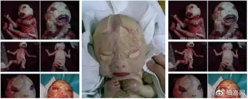 火棉胶婴儿形成原因治疗方案症状存活率