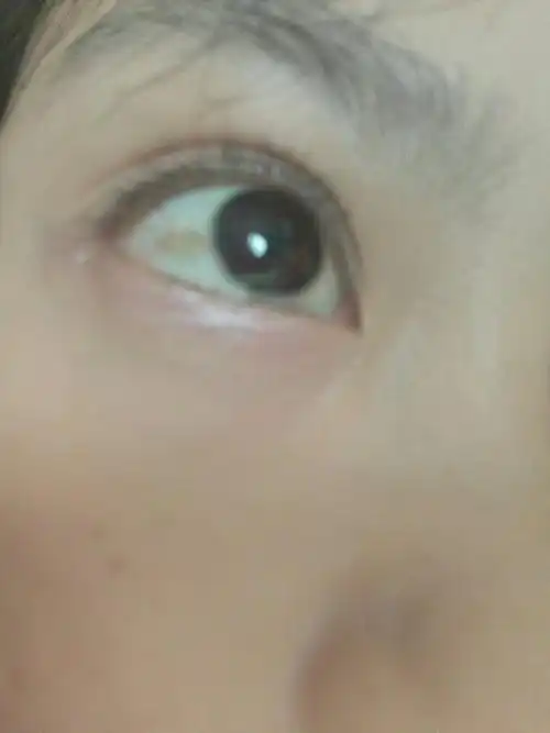 请问眼白上有黄斑是怎么回事,平时因为老是看手机和电脑,感觉眼睛有点