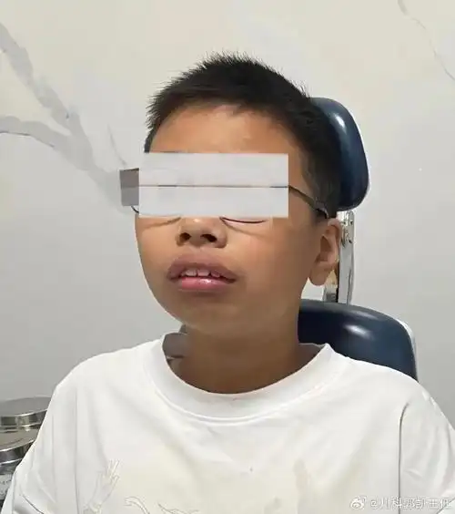 孩子可能会变成腺样体面容的5个前兆