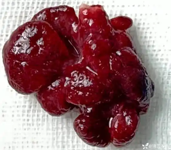 伪装成痔疮脱出的直肠息肉