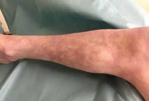 血管炎算重大疾病吗 血管炎是大病吗