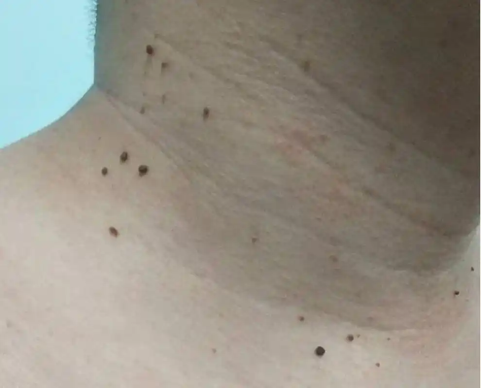 丝状疣是由hpv感染引起的一种皮肤疾病,常见于脸部,眼睑周围,嘴唇