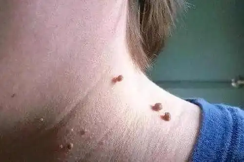 体检查出女性感染了hpv病毒,我该怎么办?怎么预防宫颈癌?