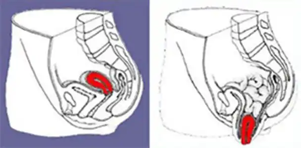 子宫脱垂图片大全