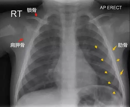 儿童肺炎时胸片怎么看呢