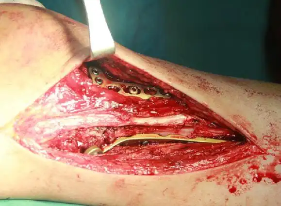 伸膝内翻型胫骨平台骨折的手术治疗 - 好大夫在线