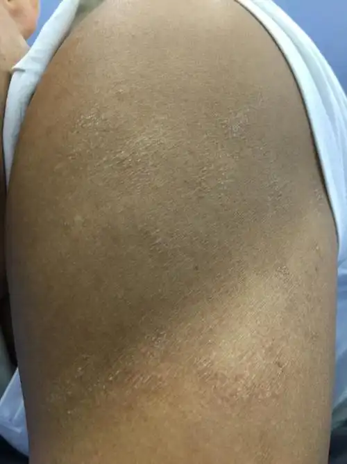 像被烫了一样皮肤皱