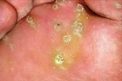 【病毒疣】疣的临床表现及其分型,图片_寻常疣_症状_症状表现 - 好