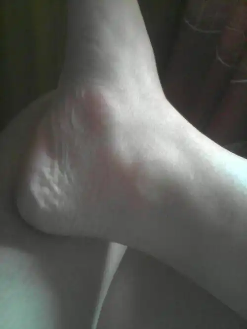 骨膜炎.怎么办?