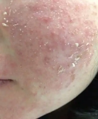 激素脸脱皮怎么办