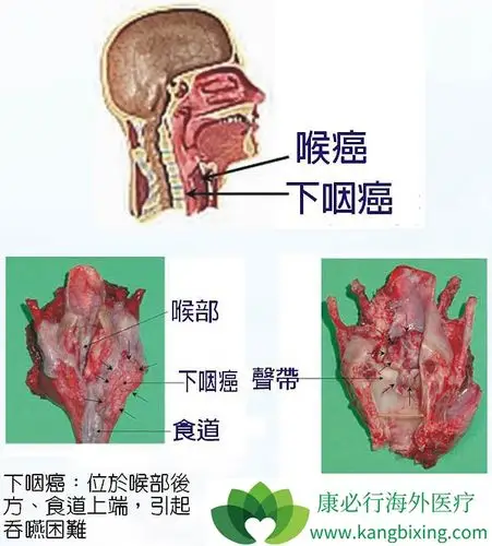 早期咽喉癌症状常见的有咳嗽声音嘶哑等