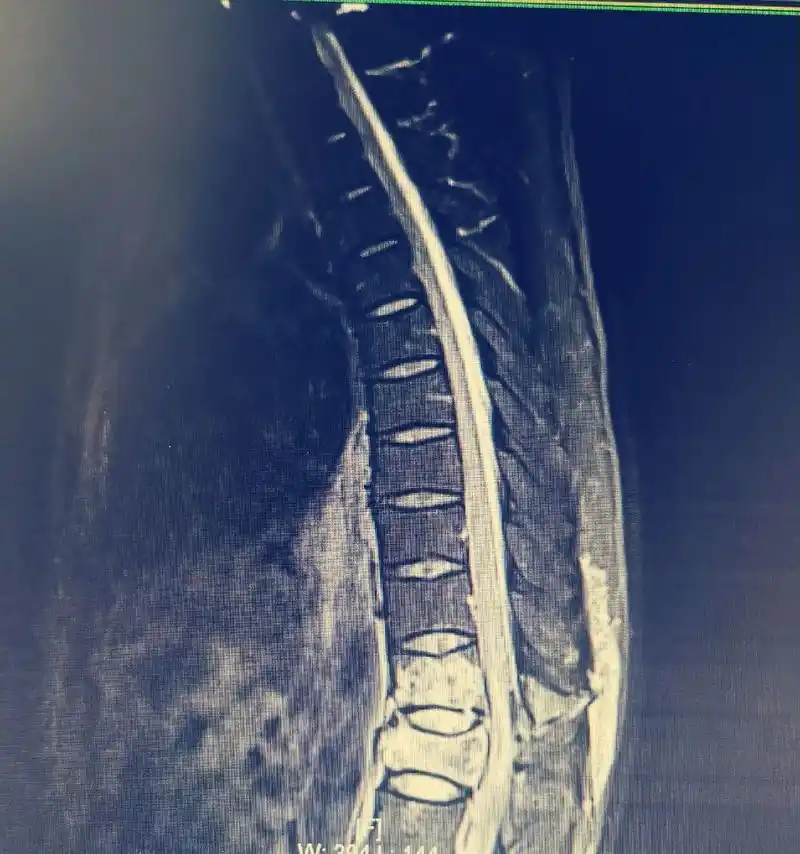 t12椎chance骨折并截瘫(指数5)#切开复位减压内固定 - 抖音