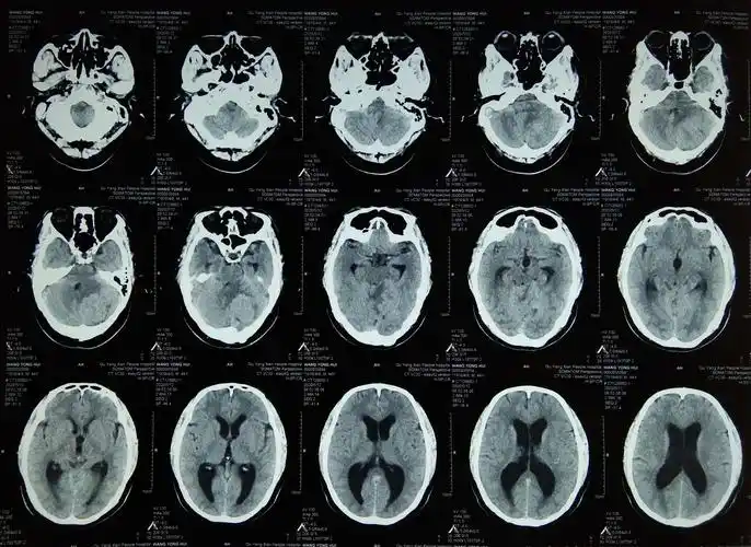 曲阳县人民医院外三科显微镜下小脑脑膜瘤切除术