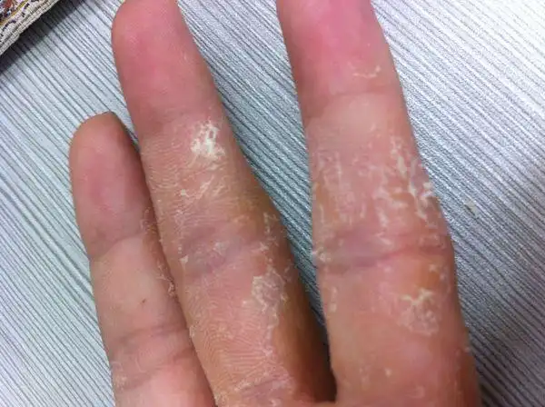 手上起泡,痒,爆白皮