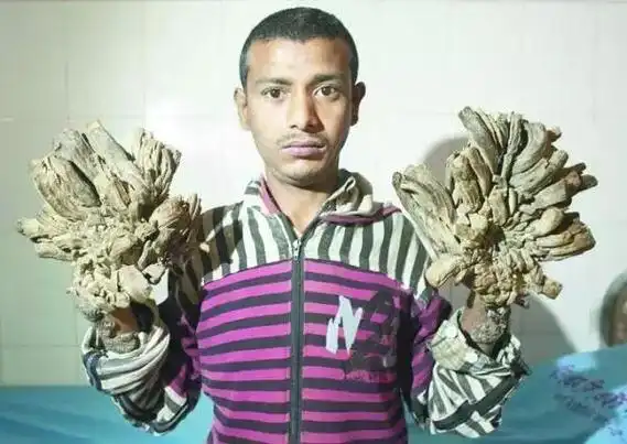 7岁男童手脚长树根 成"树人"这是一种什么病?