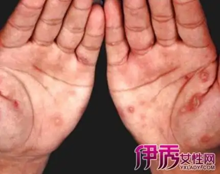 【图】盘点男人淋病早期症状图 男女性淋病症状有哪些