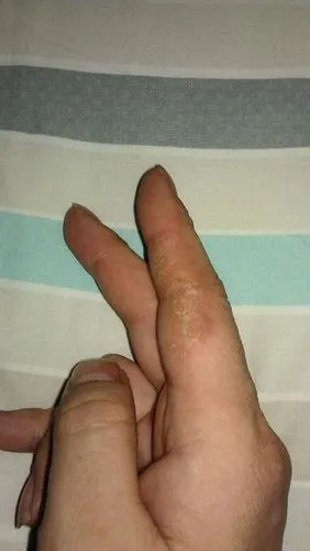 手指皮肤病(手指下起密麻针眼大小的水泡,然后干裂 反复出现)跪求高手