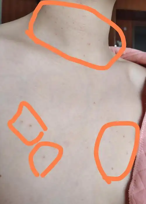 求治传染性软疣经验