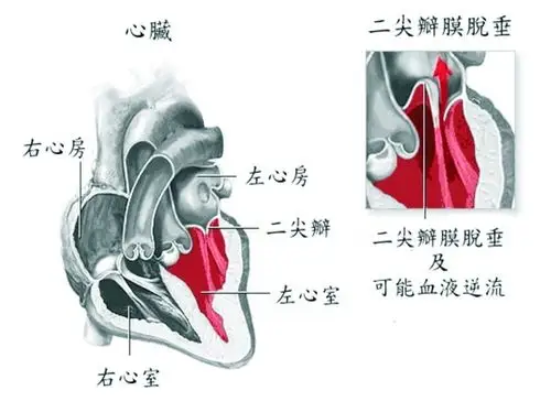 heart:二尖瓣脱垂是开角型青光眼的显著预测因素