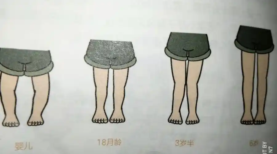 小编婴幼儿的腿通常看起来是弯曲的,事实上,很多宝宝在一岁前出现胫骨
