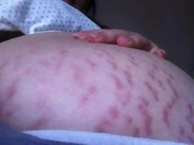 原来妊娠纹一共有3种颜色