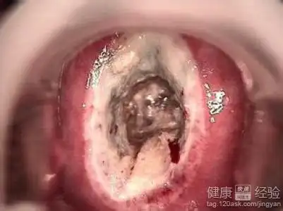 宫颈息肉癌变症状表现有哪些?