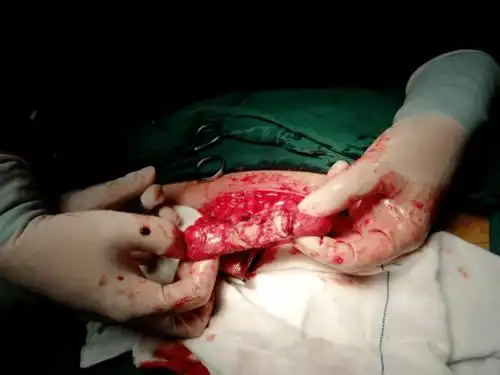 刺穿腹腔,急诊拨打120接入我院,当时的情况十分凶险,患者腹部流血不止