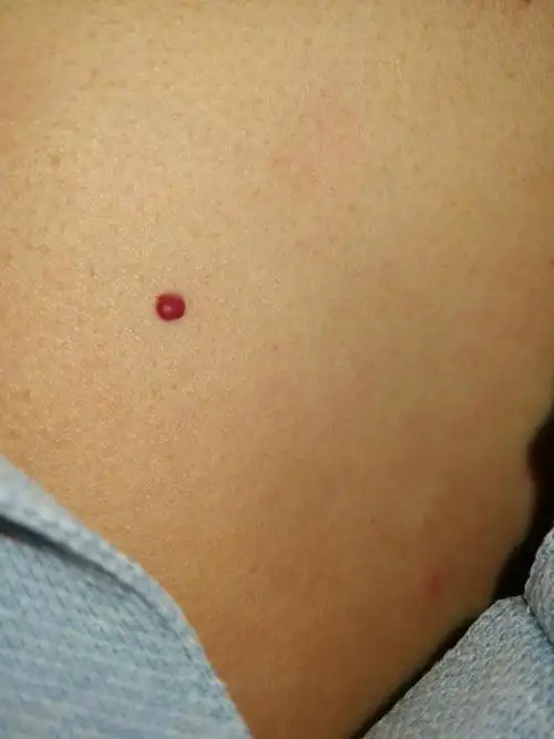 樱桃状血管瘤or老年性血管瘤