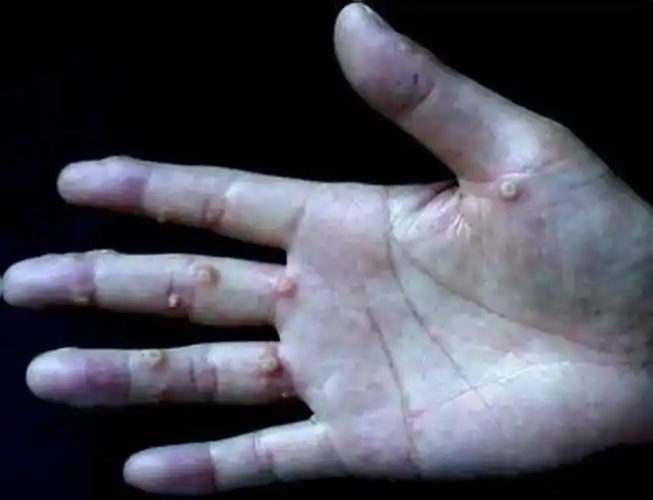 手掌上的扁平疣图片