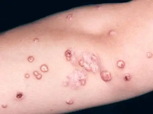 夏天游泳常中招! 传染性软疣疾病探究