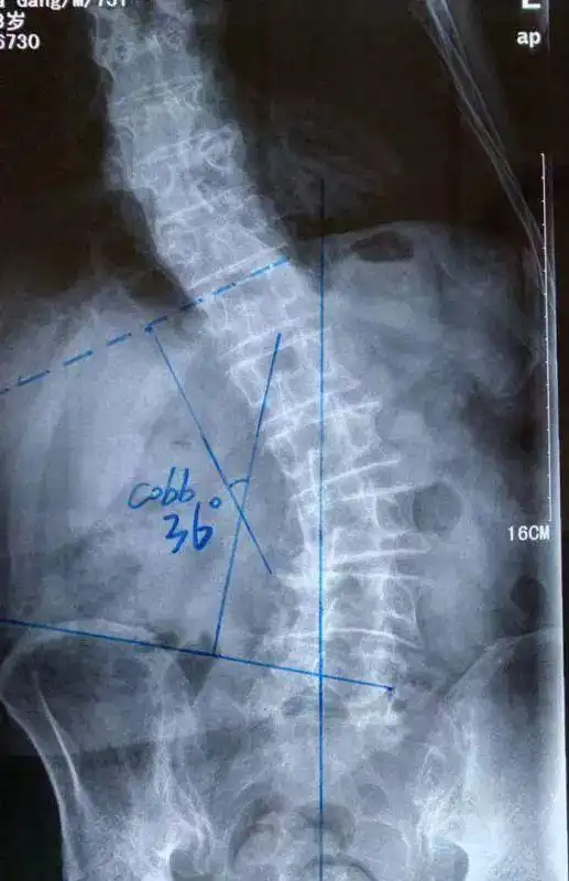 老人腰杆突然侧弯近40度,路都没法走了!
